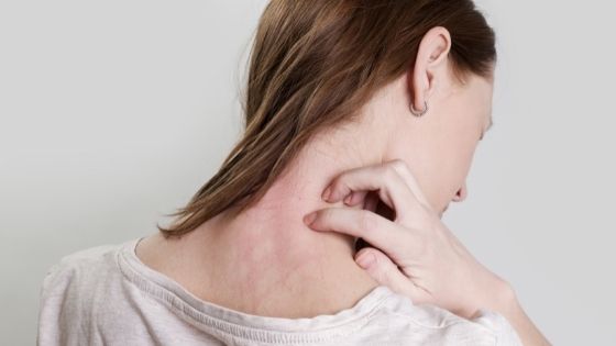 Know About the Psoriasis Complications and Treatments