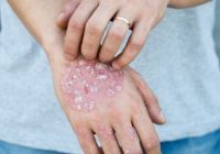 Most Effective Homeopathic Treatment for Psoriasis