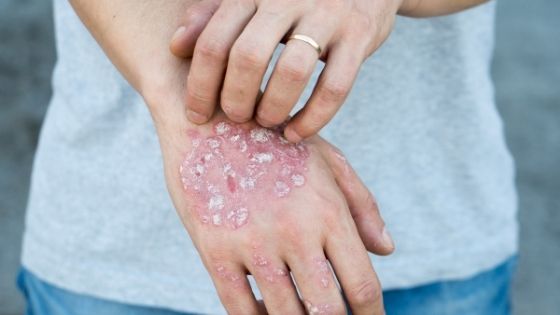 Most Effective Homeopathic Treatment for Psoriasis