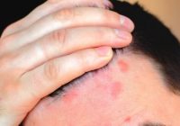 Homeopathic Remedies to Treat Scalp Psoriasis and Itching