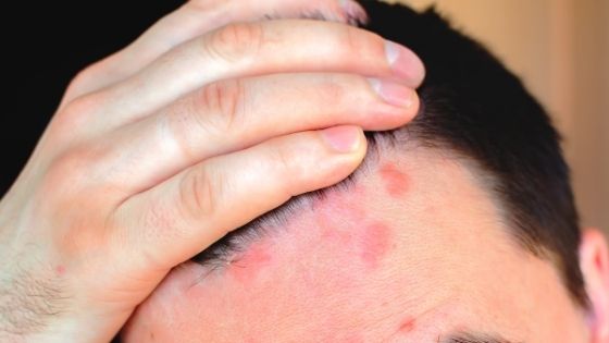 Homeopathic Remedies to Treat Scalp Psoriasis and Itching
