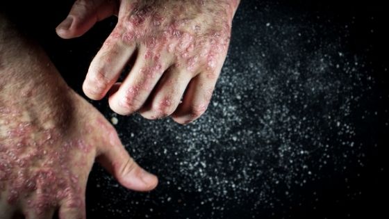 What is Psoriasis and How to Treat This Condition?