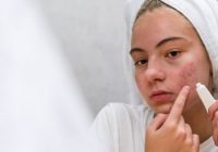 What Causes Acne and How to Remove Them?