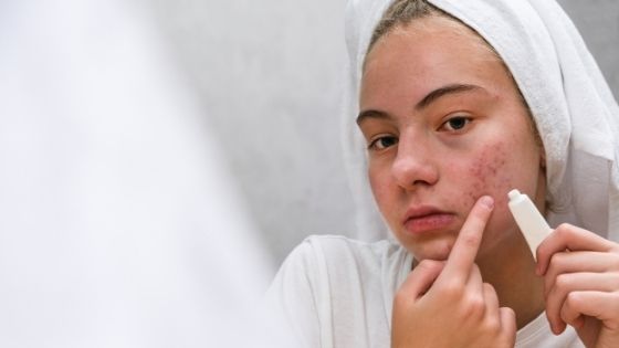What Causes Acne and How to Remove Them?