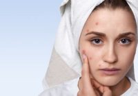 What are The Top Ways to Treat Acne Problems?