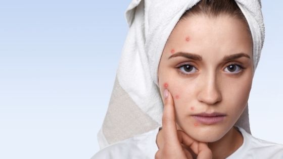 What are The Top Ways to Treat Acne Problems?