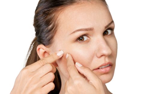 How to Prevent and Treat Acne Issues