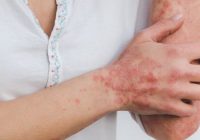 Is Psoriasis Genetic What are Its Causes and Treatment Options