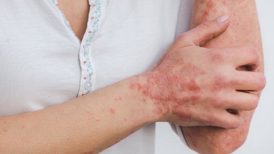 Is Psoriasis Genetic What are Its Causes and Treatment Options