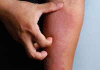 What can Cause Dermatitis and How to Treat It?