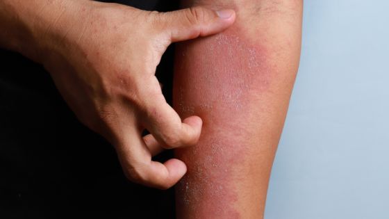 What can Cause Dermatitis and How to Treat It?