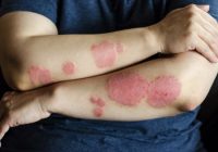 Effective Homeopathic Treatment to Cure Psoriasis