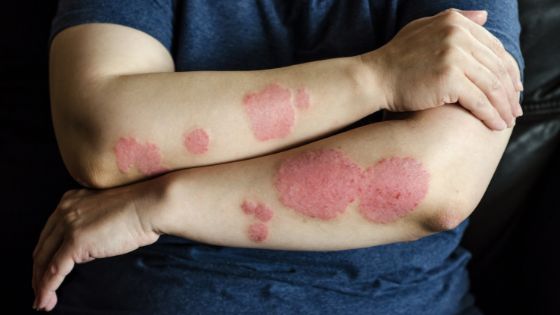 Effective Homeopathic Treatment to Cure Psoriasis