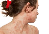 Best Natural Ways To Treat Skin Allergies