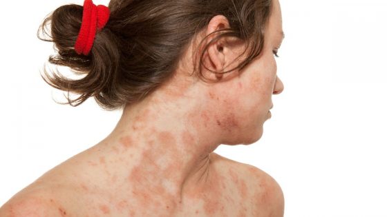 Best Natural Ways To Treat Skin Allergies