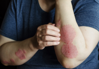 Effective Treatments for All Types and Severities of Psoriasis