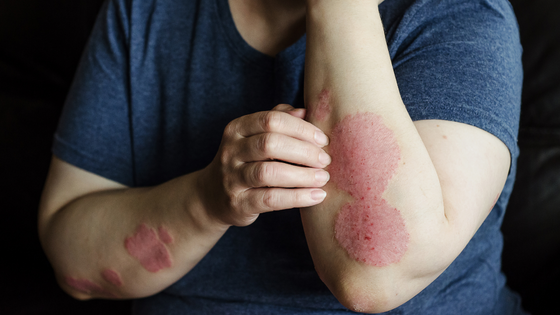 Effective Treatments for All Types and Severities of Psoriasis