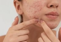 What Causes Acne Scars and How to Treat Them Naturally?