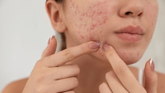 What Causes Acne Scars and How to Treat Them Naturally?