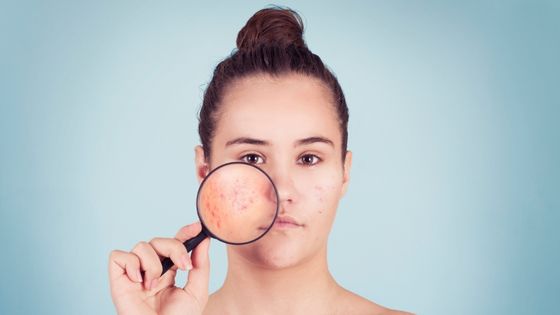 What Causes Acne on Your Face and How to Treat It?