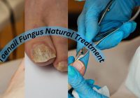 Toenail Fungus Natural Treatment